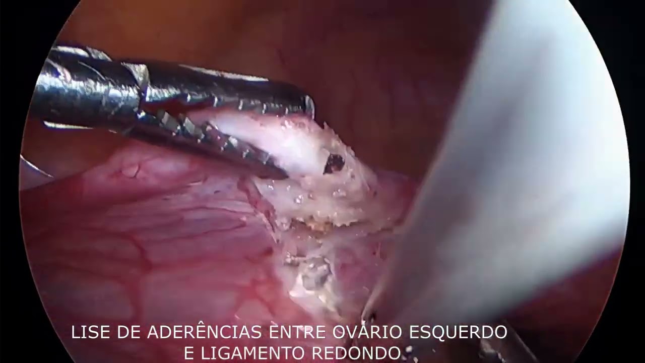 Ooforoplastia laparoscópica e exérese de lesão de endometriose profunda 